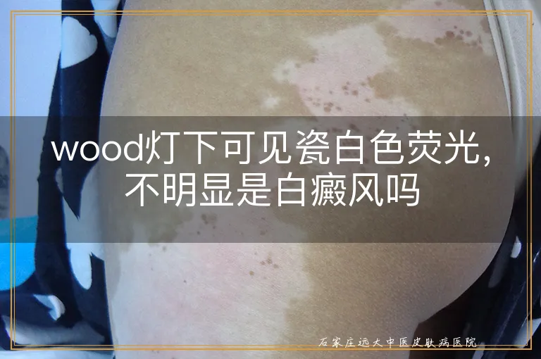 wood灯下可见瓷白色荧光，不明显是白癜风吗