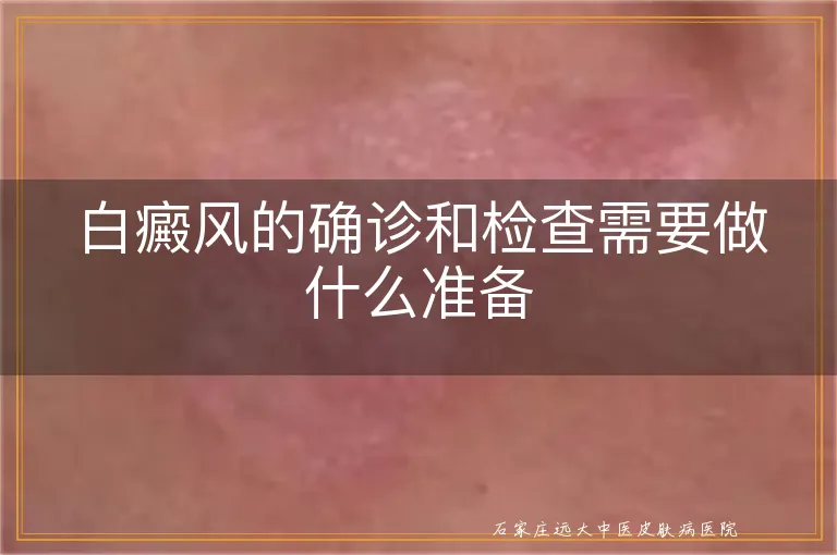 白癜风的确诊和检查需要做什么准备