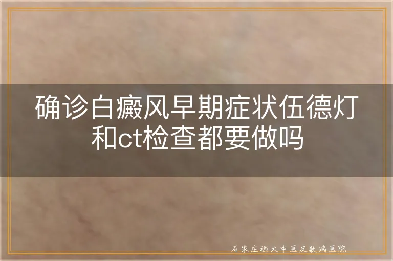 确诊白癜风早期症状伍德灯和ct检查都要做吗