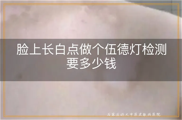 脸上长白点做个伍德灯检测要多少钱