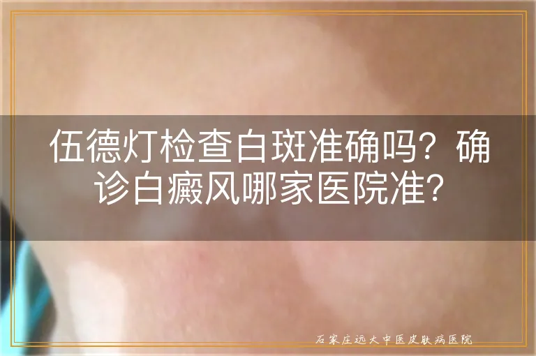 伍德灯检查白斑准确吗？确诊白癜风哪家医院准？