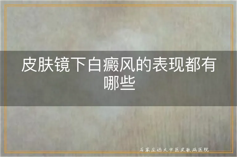 皮肤镜下白癜风的表现都有哪些