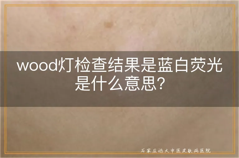 wood灯检查结果是蓝白荧光是什么意思？