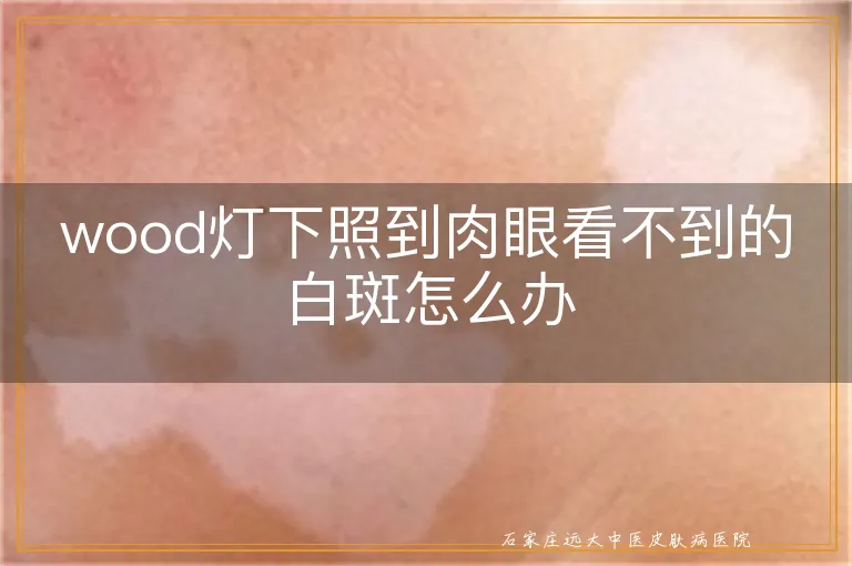 wood灯下照到肉眼看不到的白斑怎么办