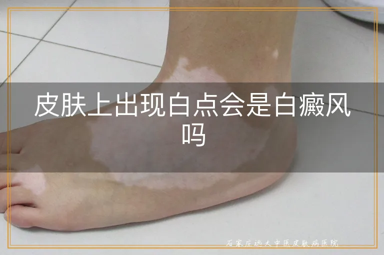 皮肤上出现白点会是白癜风吗