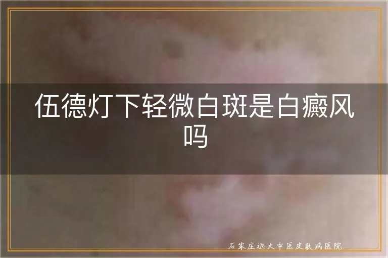 伍德灯下轻微白斑是白癜风吗