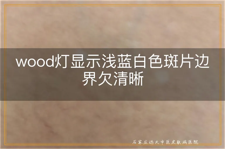 wood灯显示浅蓝白色斑片边界欠清晰