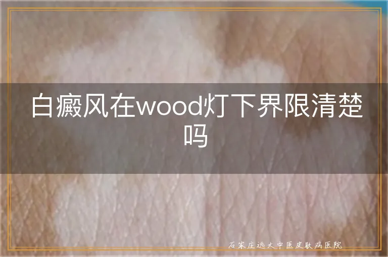 白癜风在wood灯下界限清楚吗