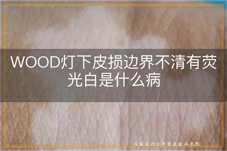 WOOD灯下皮损边界不清有荧光白是什么病