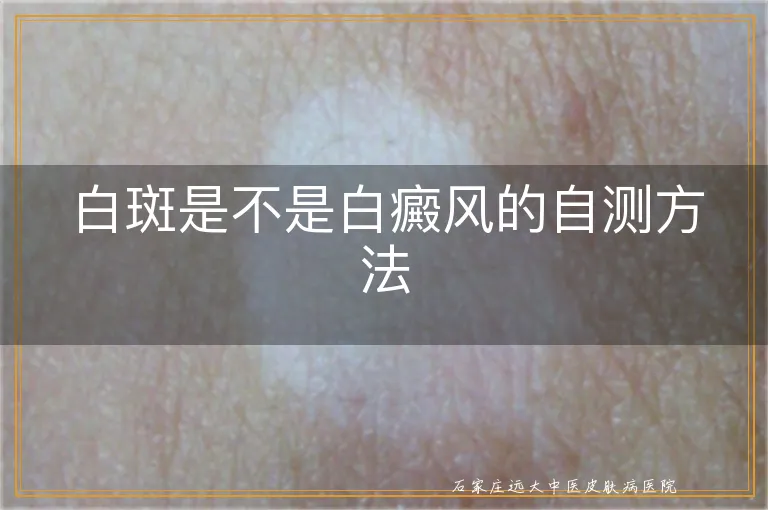 白斑是不是白癜风的自测方法