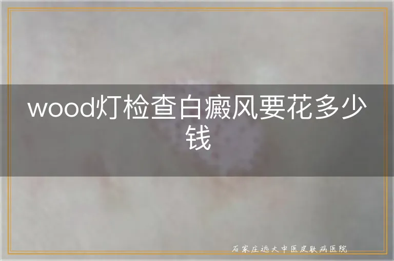 wood灯检查白癜风要花多少钱