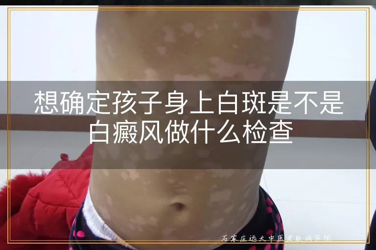 想确定孩子身上白斑是不是白癜风做什么检查