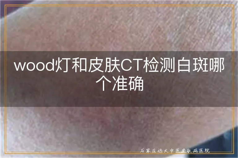 wood灯和皮肤CT检测白斑哪个准确