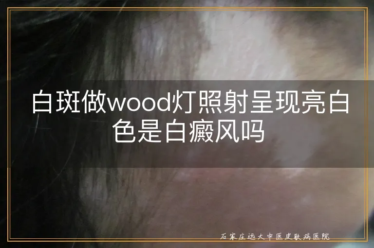 白斑做wood灯照射呈现亮白色是白癜风吗