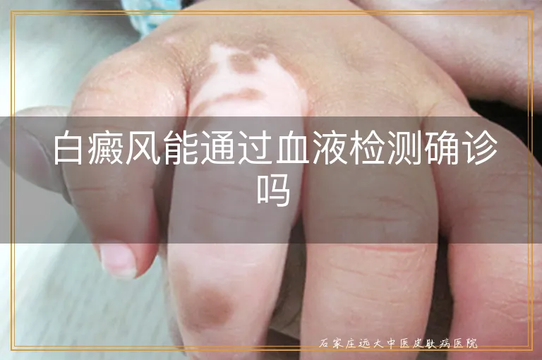 白癜风能通过血液检测确诊吗