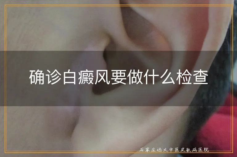 确诊白癜风要做什么检查