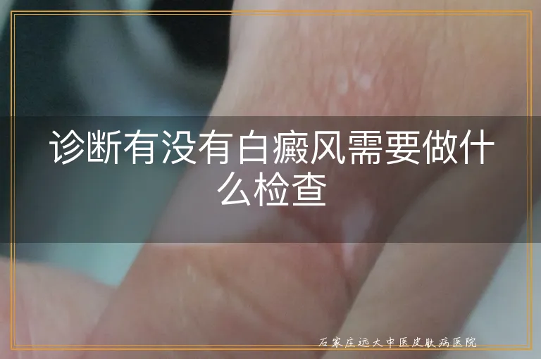 诊断有没有白癜风需要做什么检查