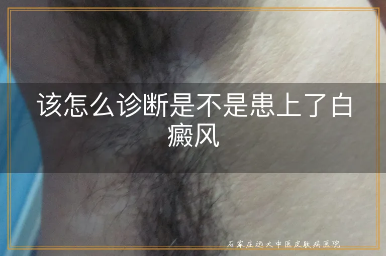 该怎么诊断是不是患上了白癜风