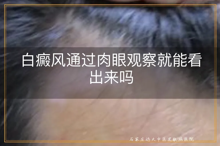 白癜风通过肉眼观察就能看出来吗