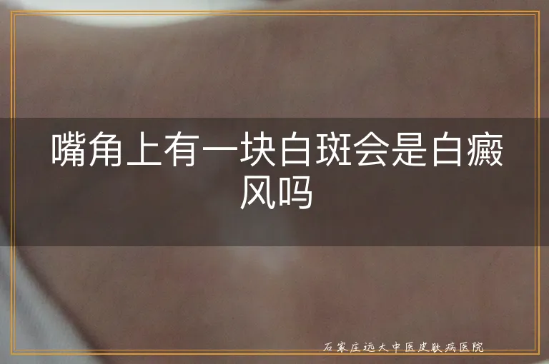 嘴角上有一块白斑会是白癜风吗