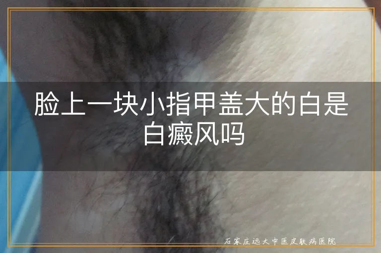 脸上一块小指甲盖大的白是白癜风吗