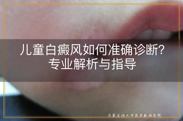 儿童白癜风如何准确诊断？专业解析与指导