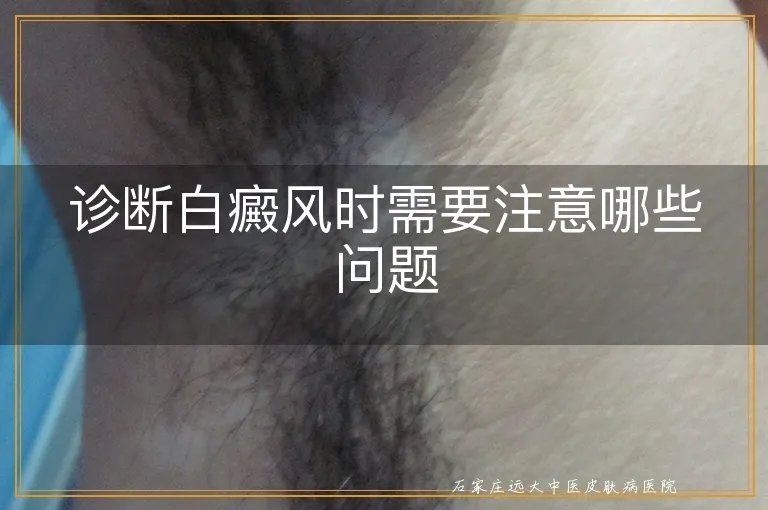 诊断白癜风时需要注意哪些问题