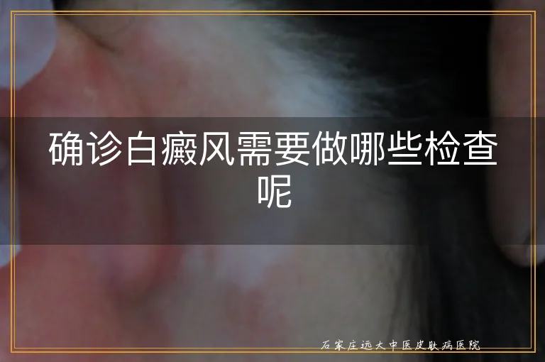 确诊白癜风需要做哪些检查呢