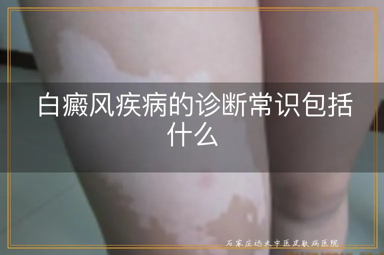 白癜风疾病的诊断常识包括什么