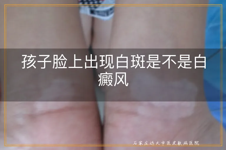 孩子脸上出现白斑是不是白癜风