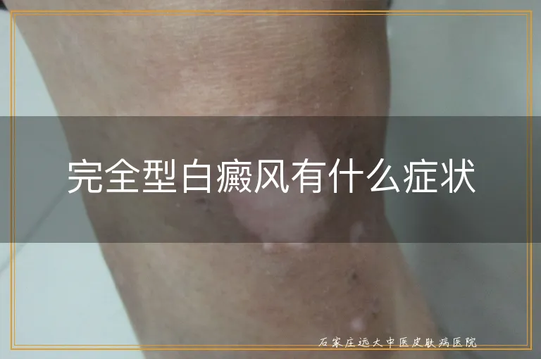 完全型白癜风有什么症状