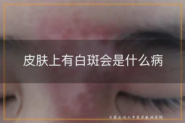 皮肤上有白斑会是什么病