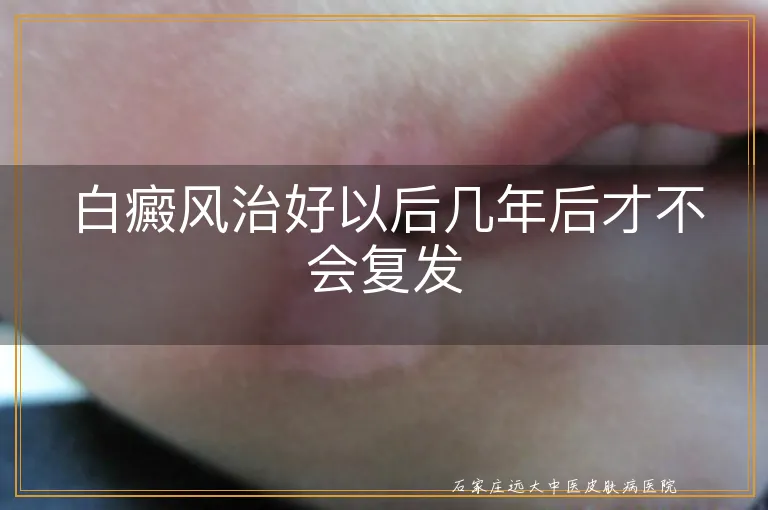 白癜风治好以后几年后才不会复发