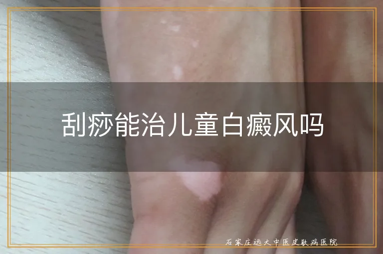 刮痧能治儿童白癜风吗