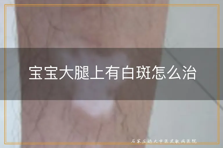 宝宝大腿上有白斑怎么治