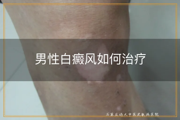 男性白癜风如何治疗