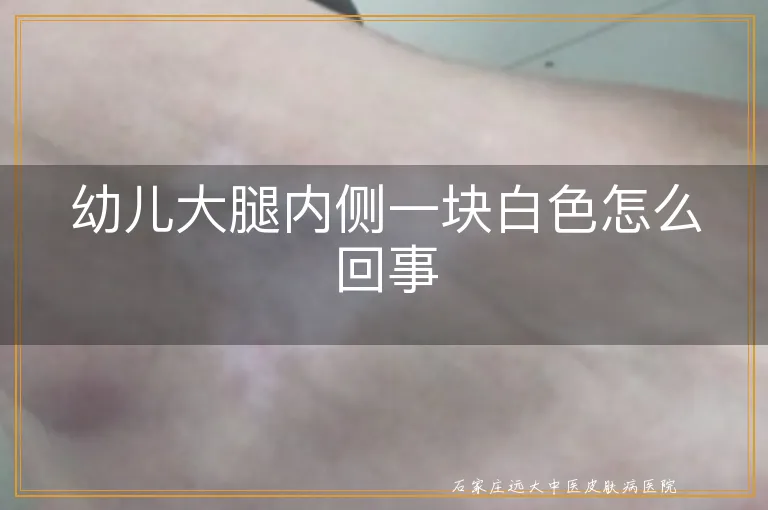 幼儿大腿内侧一块白色怎么回事