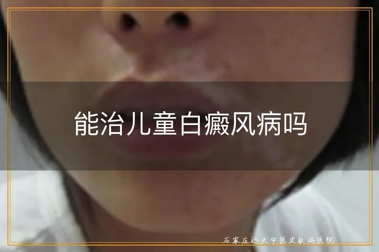 能治儿童白癜风病吗