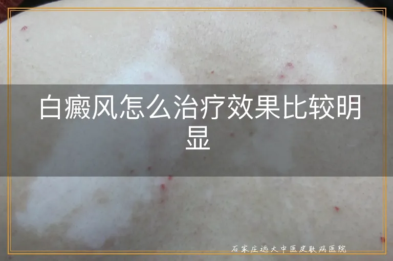 白癜风怎么治疗效果比较明显