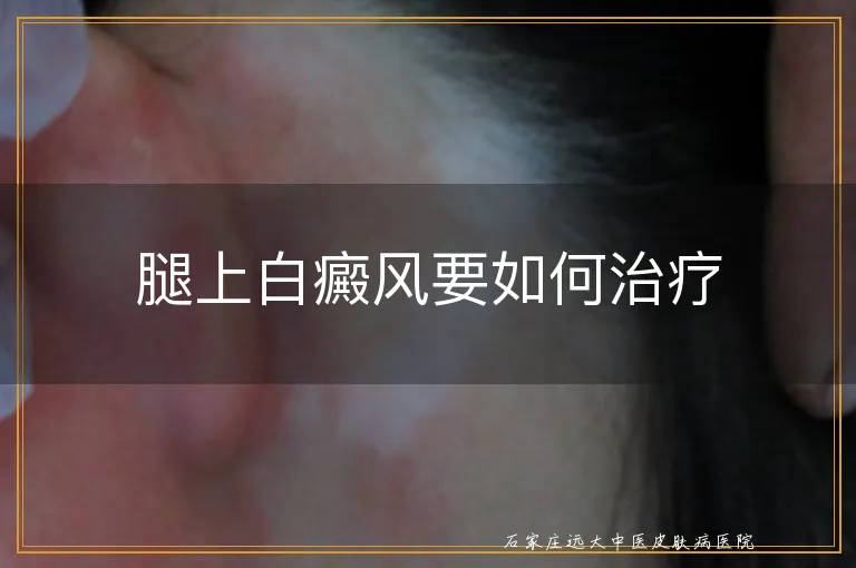 腿上白癜风要如何治疗