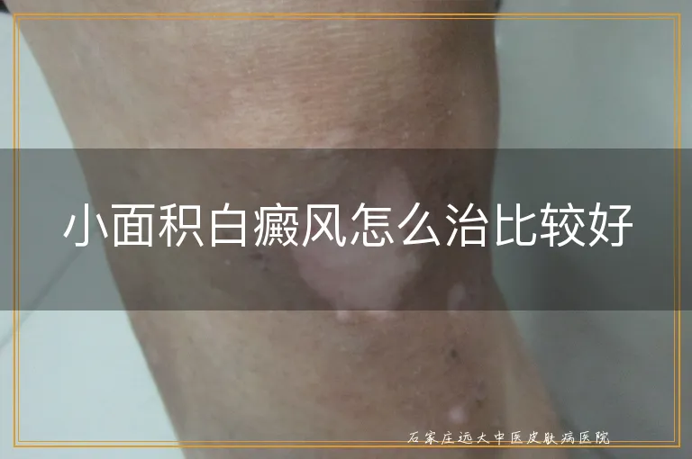 小面积白癜风怎么治比较好