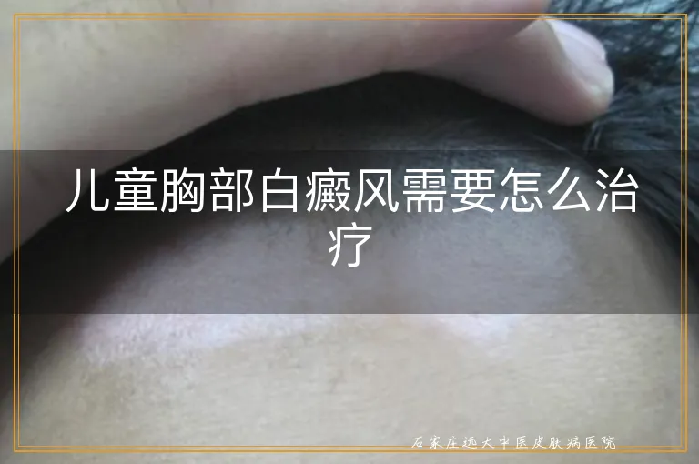 儿童胸部白癜风需要怎么治疗