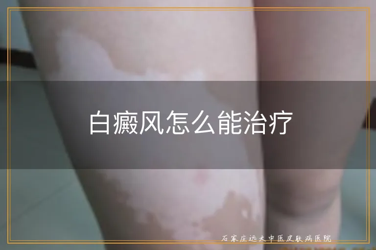 白癜风怎么能治疗