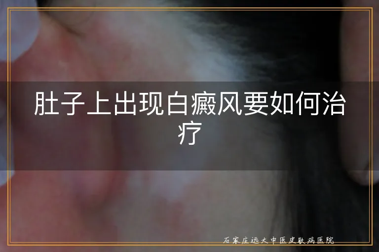 肚子上出现白癜风要如何治疗