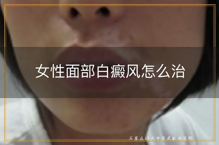 女性面部白癜风怎么治