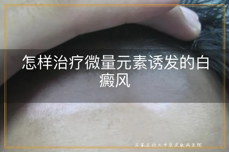 怎样治疗微量元素诱发的白癜风