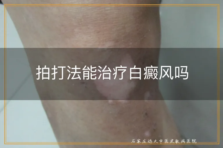 拍打法能治疗白癜风吗