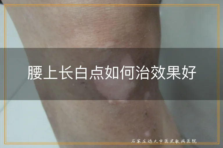 腰上长白点如何治效果好