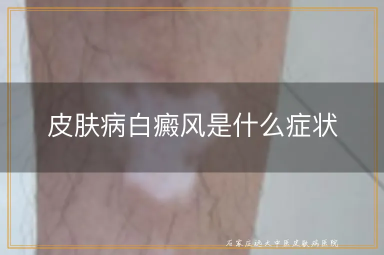 皮肤病白癜风是什么症状