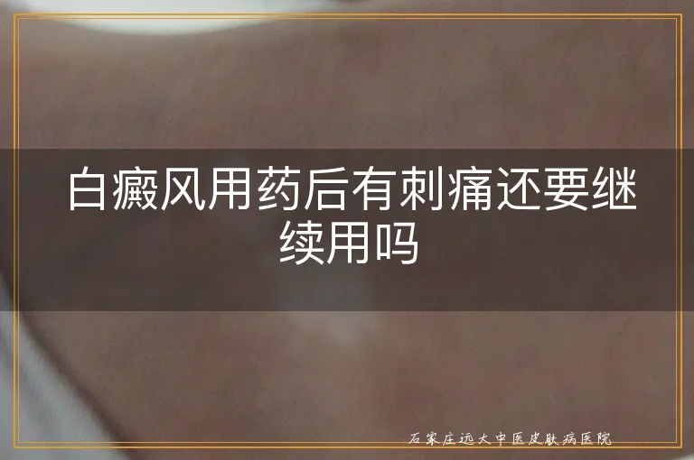 白癜风用药后有刺痛还要继续用吗